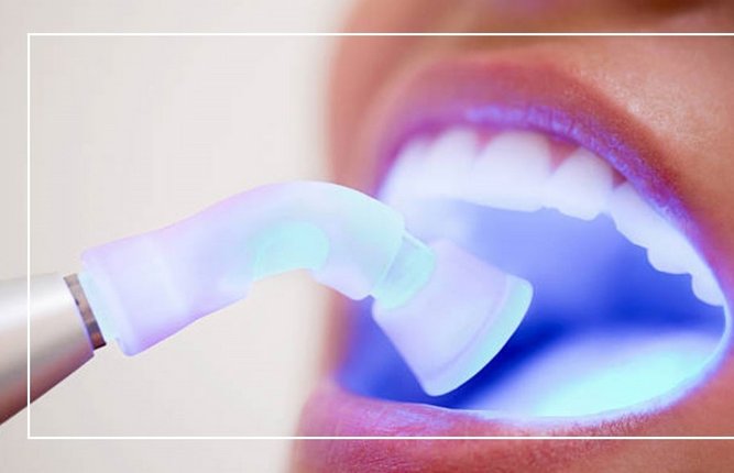 ایمپلنت آمریکایی لیزری