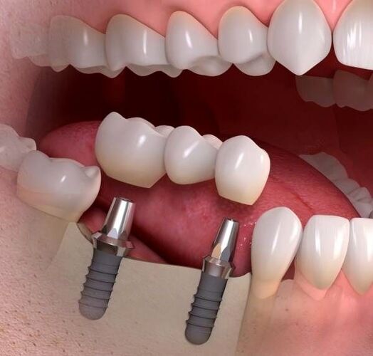 جراحی ایمپلنت دندان