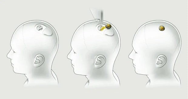 آغاز آزمایشهای انسانی توسط شرکت Neuralink