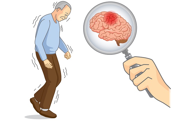 تشخیص زود هنگام بیماری پارکینسون با ساعت هوشمند