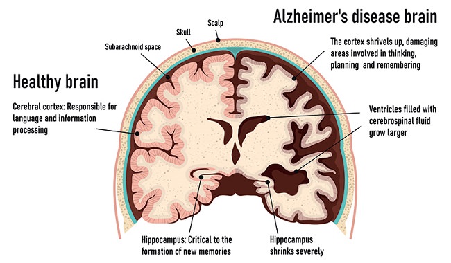 درمان بیماری آلزایمر به شیوهای جدید