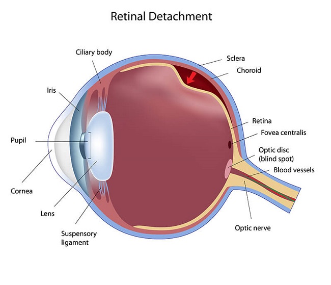 retinal-detachment-chart.jpg